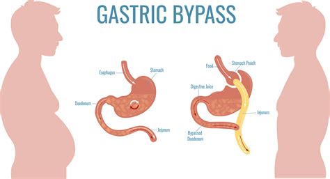 Why am I gaining so much weight after gastric sleeve?