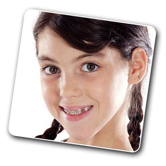 What are the 5 stages of braces?