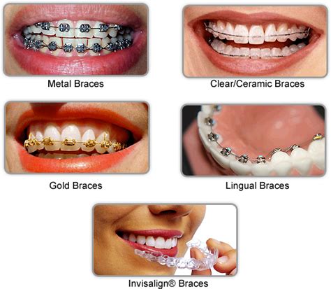 What is the most painful stage of braces?