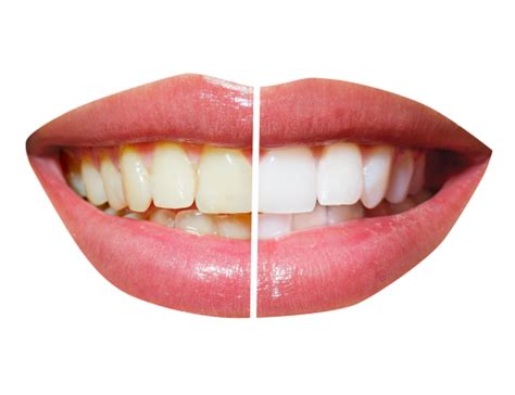What is the best thing to whiten teeth with?