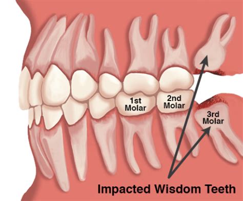 Can I eat fried chips after wisdom teeth removal?