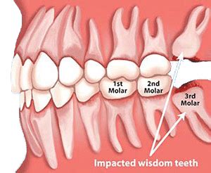 What happens if food gets in wisdom tooth hole?