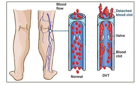 Why do anabolic steroids cause blood clots?