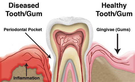 What not to do after flossing?