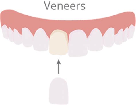 How can you tell if someone has veneers?