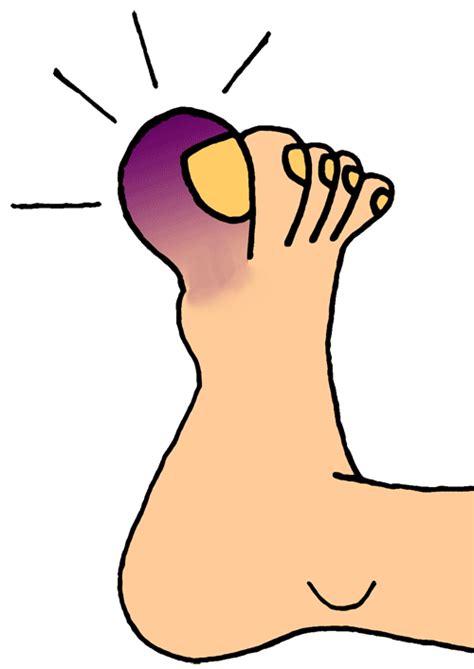Is pitting edema serious?