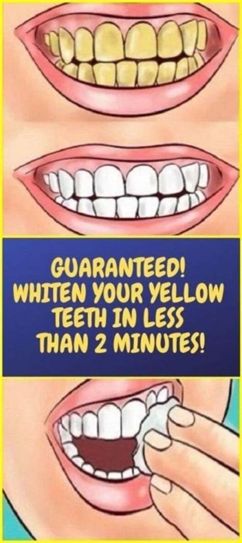 Can teeth be too yellow to whiten?
