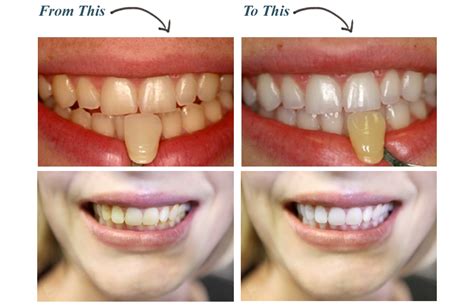 At what age do teeth start to yellow?