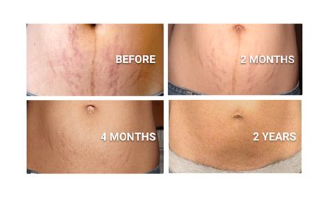 Will stretch marks go away if I lose weight?