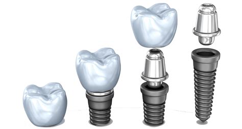 What is the most expensive part of a dental implant?