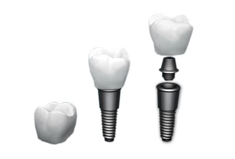 How painful is getting a tooth implant?