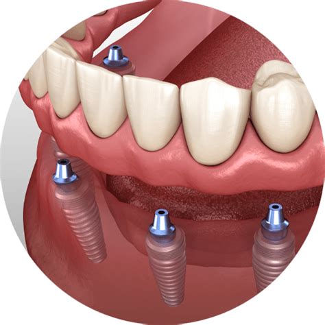 How long after an extraction can you get an implant?