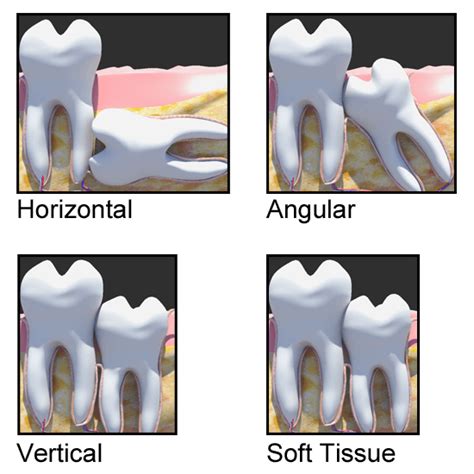 Do I need to remove my wisdom tooth if it doesn't hurt?
