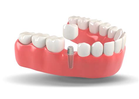 Is a tooth implant supposed to be loose?