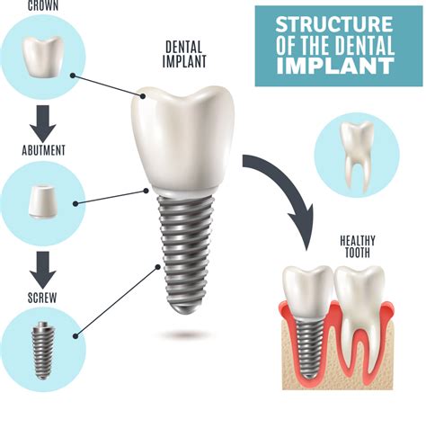 Can a xray show if dental implant is failing?
