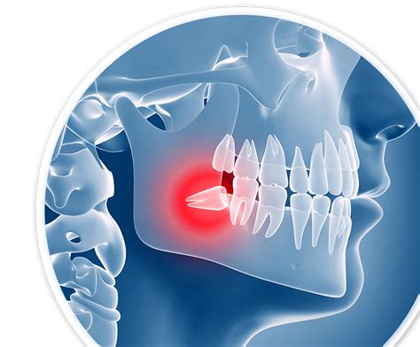 What to do if food is stuck in wisdom tooth hole?