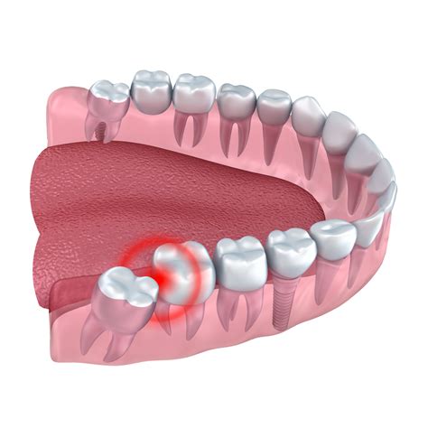 Why Cant I Open My Mouth After Wisdom Teeth Surgery? - Rewrite The Rules