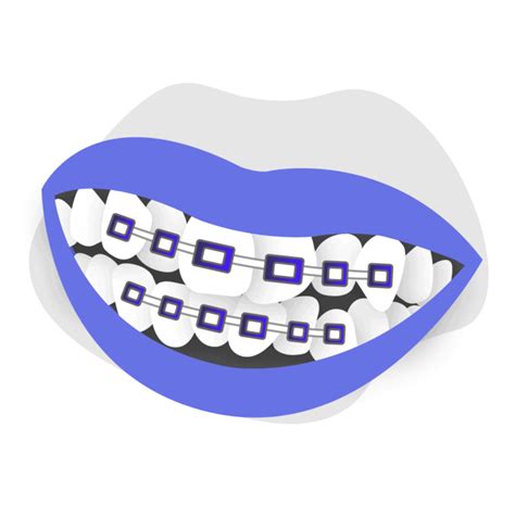 Why Do My Teeth Make A Clicking Sound With Braces? - Rewrite The Rules