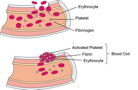 Why Do Steroids Cause Blood Clots? - Rewrite The Rules