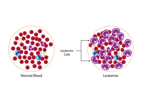 Why Is Excessive Bleeding A Common Occurrence With Acute Leukemia ...